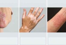 Ayush Unveils Major Skin Disease Treatment Guidelines For Psoriasis, Vitiligo And Dermatitis Ayush
